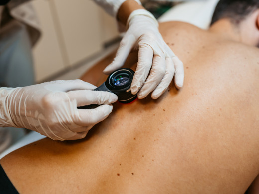 Prevence je pro úspěšnost léčby melanomu důležitá, zdůrazňuje VZP