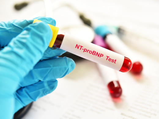 Na selhání srdce upozorní rychlý test z krve