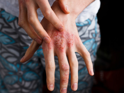 Kardiovaskulární komorbidity u atopické dermatitidy